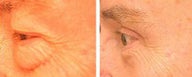 Blepharoplasty