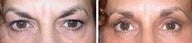 Laser Blepharoplasty and Brow Lift