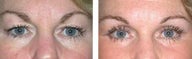 Upper and Lower Laser Blepharoplasty