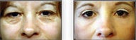 Upper and Lower Blepharoplasty