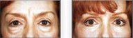 Upper and Lower Blepharoplasty