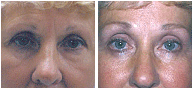 Eyelid Surgery