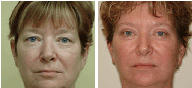 Facelift