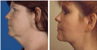 Face lift & Blepharoplasty