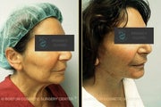 Face Lift (Reversalift)