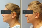 Facelift (Reversalift)