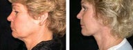 Facelift