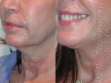 Sluplift- Mini Neck & Jowl Lift