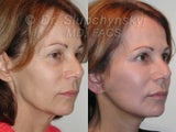 Sluplift- Mini Neck & Jowl Lift