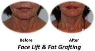 Facelift