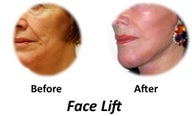 Facelift