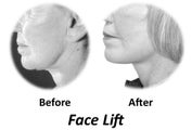 Facelift