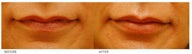 Lip Reduction/Lip Correction