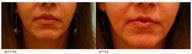 Lip Reduction/Lip Correction
