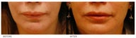 Lip Reduction/Lip Correction