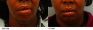 African-American Lip Reduction