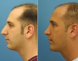 Rhinoplasty and chin implant on a male side view
