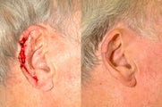 Ear Reconstruction after Cancer Excision