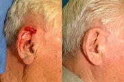Ear Reconstruction after Cancer Excision
