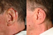 Ear Reconstruction after Cancer Excision