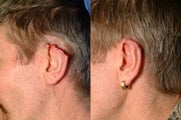 Ear Reconstruction after Cancer Excision