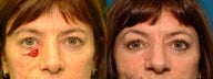 Eyelid Reconstruction