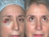 Eyelid Reconstruction