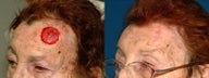 Forehead Reconstruction after Cancer Excision