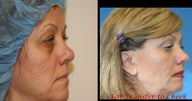 Fat transfer or fat grafting with PRP