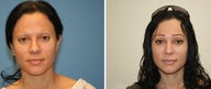 Fat transfer to face