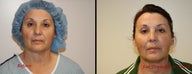 Fat transfer to face