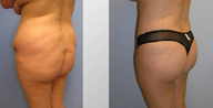 Butt Augmentation (Fat Transfer)