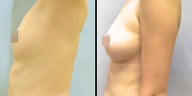 Fat Transfer