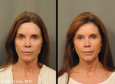 Facial Fat Grafting