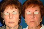 Brow Lift / Forehead Lift
