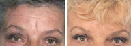 Forehead Lift