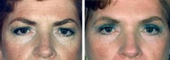 Forehead Lift