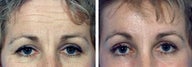 Forehead Lift