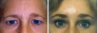 Forehead Lift