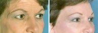 Forehead Lift