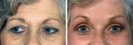 Forehead Lift