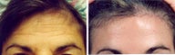 Forehead Lift