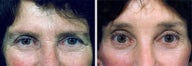 Forehead Lift