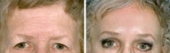 Forehead Lift