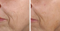Fractional Skin Resurfacing Before and After Fractional Skin Resurfacing