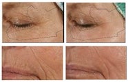 Fractional laser resurfacing