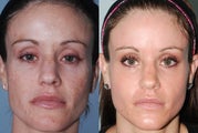 Fraxel Restore Dual Laser Treatments