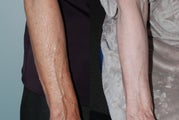 Fraxel Restore Dual Laser Treatment
