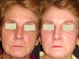 Fraxel Laser Treatment