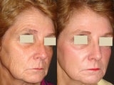 Fraxel Laser Treatment